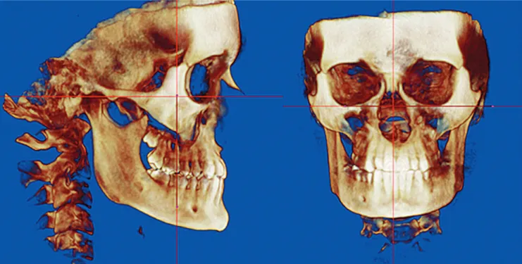 Figure 1 - Orientation in sagittal plane and in coronal plane.