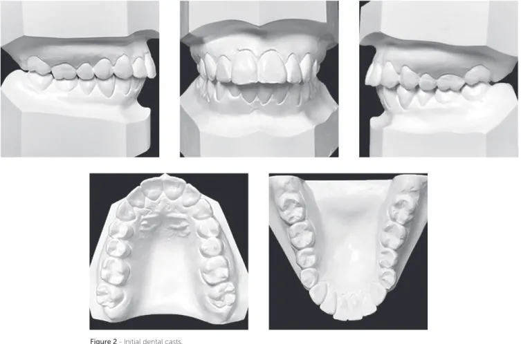 Figure 2 - Initial dental casts.