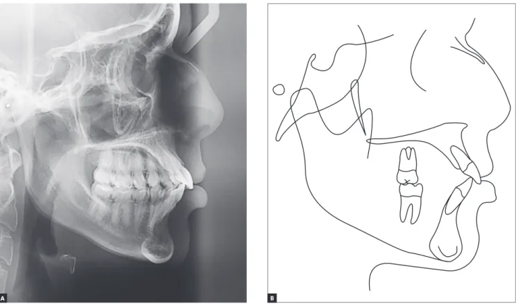 Figure 4 - Initial cephalogram (A) and cephalometric tracing (B). 