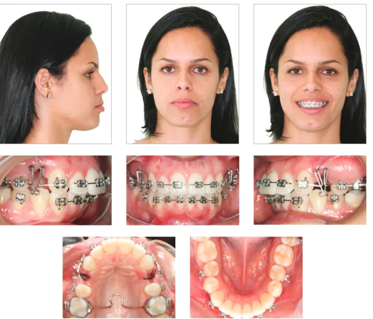 Figure 5 - Progress records (canines’ distalization).