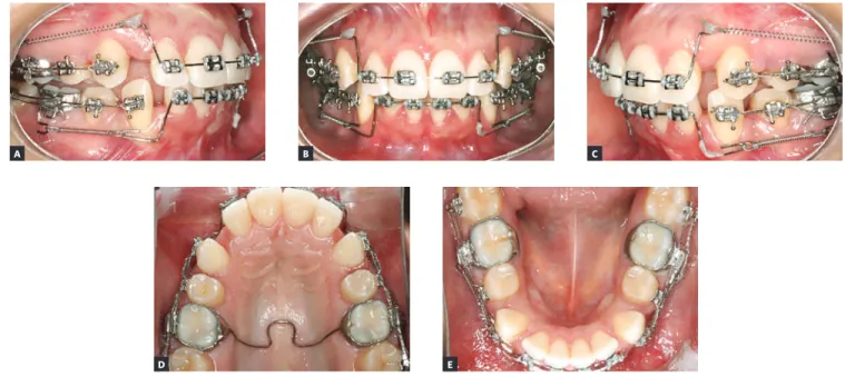 Figure 6 - Progress records (incisors’ retraction).