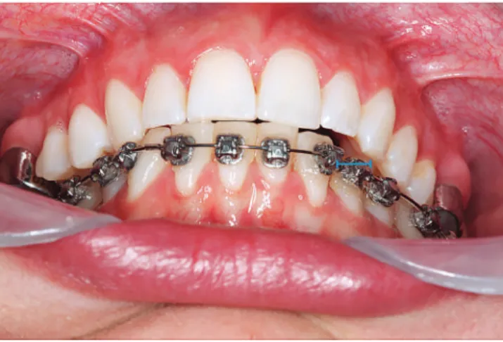 Figure 27 - The overjet created on the left cuspids will allow for an increase  on the intercanine distance in the mandibular arch, completing its ideal  align-ment