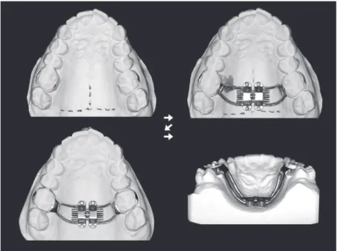 Figure 3 - Laboratory procedures: midline (pala- (pala-tal raphe) and limit between soft and hard palate  (clinically determined) traced using lead pencil  on model; selection of MSE with greatest  expan-sion capacity (8, 10 or 12 mm) that can be placed  f