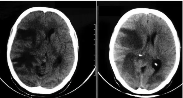 Figure 1. Head computed tomography showing a hypodensity area in the right frontal-parietal region with  mass effect and midline deviation.