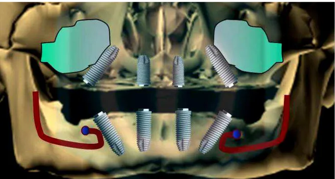 Figura  01  -  Sugestão  para  inclinação  de  implantes  distais  em  mandíbula  e  maxila edêntulas