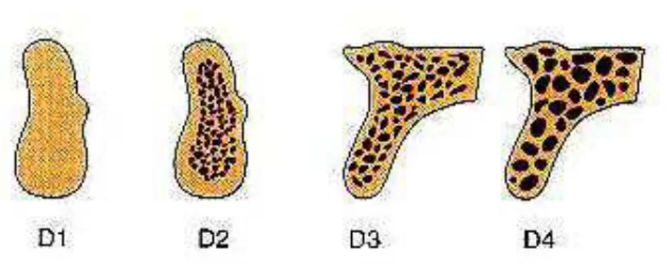 Figura 07 - Diferentes classificações de densidades ósseas. 