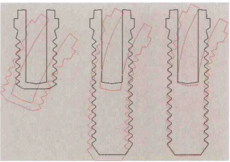 FIGURA 4 – Diagrama mostrando o movimento de implantes de  diferentes comprimentos no osso (amplificação 300x)