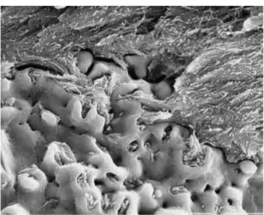 Figura 7 - Microscopia eletrônica demonstrando a migração óssea  em direção à superfície do implante (irregular, porosa e rugosa)  Fonte: BALSHI, 2002