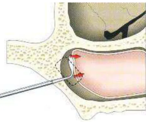 Figura 21 - Esquematização do completo afastamento da mucosa sinusal  Fonte: BALSHI, 2002