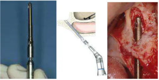 Figura 30 - Captura e instalação do implante no sítio cirúrgico  Fonte: BALSHI, 2002 