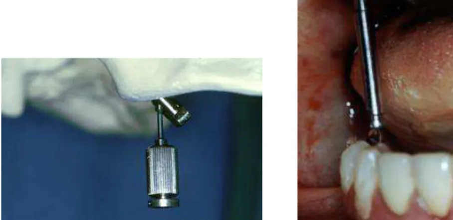 Figura 32 - Remoção do parafuso do sistema Stargrip verificando  correto posicionamento da plataforma do implante 