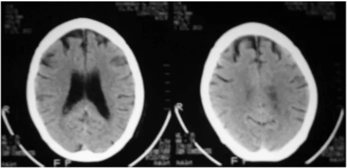 Figure 2. Brain SPECT showing moderate hypoperfusion in frontal  lobes.