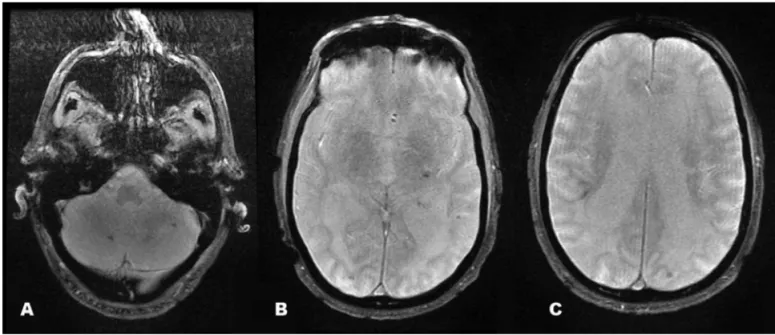 Figure 2. Axial T2* images showing multiple areas with marked hypointensity suggestive of hemossiderin content [A-C].