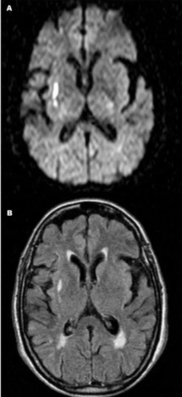 Figure 2. Axial diffusion-weighted magnetic resonance image [A] 