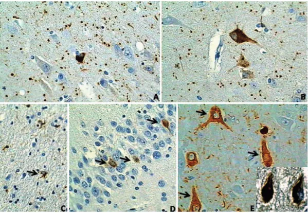 Figure 1. Neuropathological features of argyrophilic grain disease. All the histological slides are immunostained  with PHF-1 antibody against phospho-tau