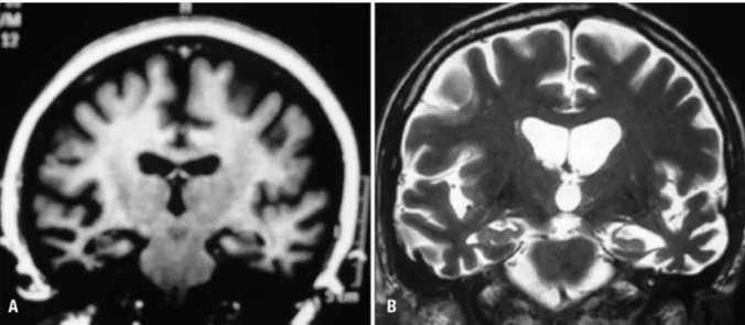 Figure 1. Examples of structural imaging (MRI) of cases 1 and 3. [A] Case 1. Anterior temporal lobe atrophy, more prominent  on right side; [B] Case 3