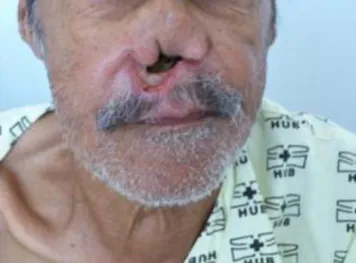 Figura 8 - Paciente 2 do sexo masculino com leishmaniose mucosa grave do septo nasal com   desfiguração facial