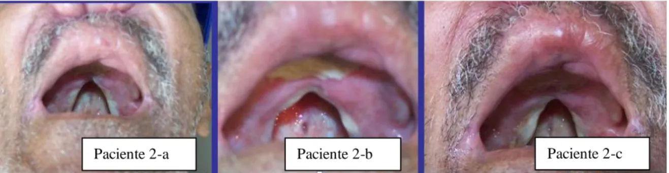 Figura  10  -  Paciente  2  com  Leishmaniose  mucocutânea:  (a)  infiltração  do  palato  duro  e  mole; 