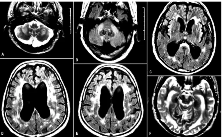Figure 2. Hyperintensities in both middle cerebellar peduncles seen in T2 (A) and in FLAIR acquisitions(B); ventricle dilatation, hyperintensities  in periventricular white matter and in splenium of corpus callosum in FLAIR(C); hyperintensities in the peri