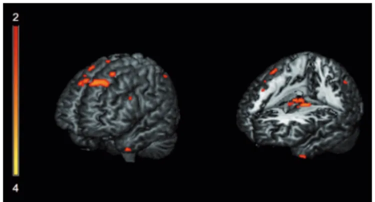 Figure 2. Areas exhibiting significant correlation with spontaneous  semantic errors on BNT