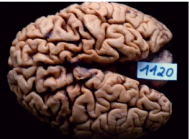 Figure 2.  Gross analysis shows significant moderate to severe  bilateral frontotemporal atrophy.