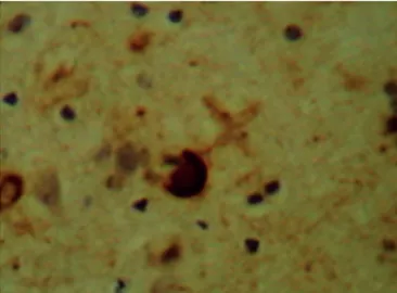 Figure 5. Immunohistochemistry reaction shows antibodies against  tau proteins in arc in frontal lobe and also neuronal loss.