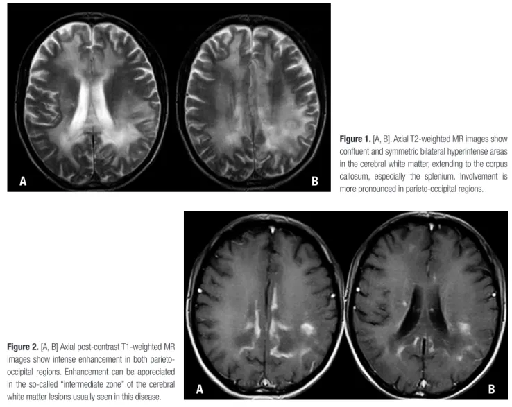 Figure 1. [A, B]. Axial T2-weighted MR images show  confluent and symmetric bilateral hyperintense areas  in the cerebral white matter, extending to the corpus  callosum, especially the splenium