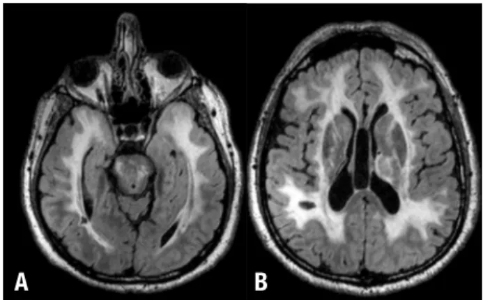 Table 2. Calculation of hyperintense brain lesion volume on FLAIR sequence.
