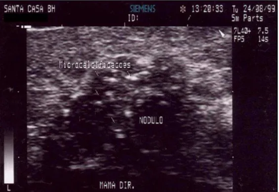 FIGURA 3: Caracterização ultra-sonográfica de uma imagem nodular  demonstrando a presença de microcalcificações intratumorais