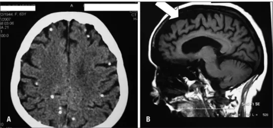 Figure 1. [A] Unenhanced computed tomography (CT Scan of the brain) showing multiple calcified lesions