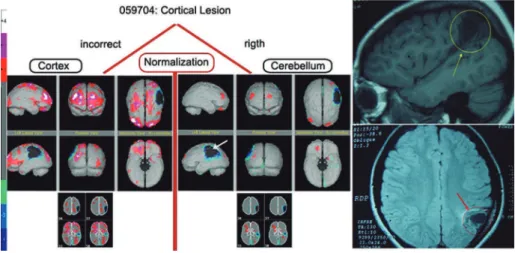Figure 2. MRI and normalization types of case 1.