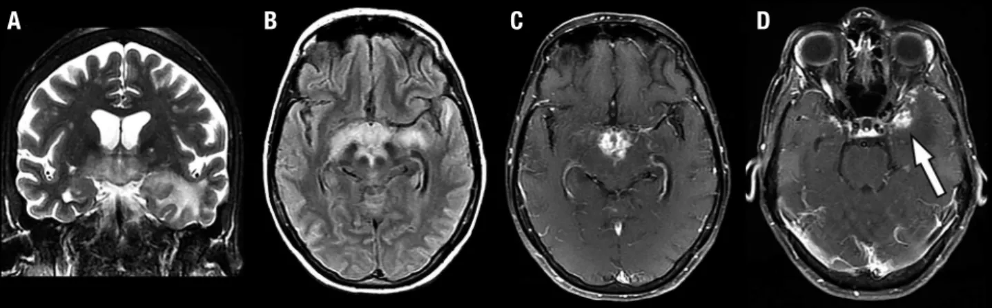 Figure 2. Case 1: Follow-up MRI. Coronal T2-weighted [A], axial FLAIR [B], and axial contrast-enhanced T1-weighted images [C and D] demonstrate almost  complete resolution of the findings.