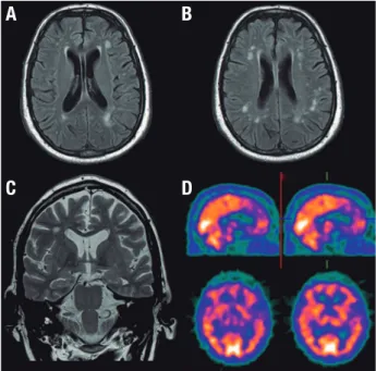 Figure 1. Flair MRI: Hyperintensity on deep white matter axial scans [A and  B] and coronal images showing mild hippocampal atrophy [C]; Brain SPECT: 