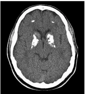 Figure 3. 23 year-old subject with massive brain calcinosis, but only with  mild symptoms, suggesting a high level of resilience for brain calcinosis.