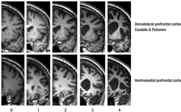 Figure 1. Shows the array of MR reference images and rating criteria employed in judging atrophy in the frontal lobe brain regions