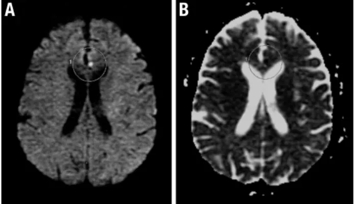Figure 1. [A] Hyper signal in the diffusion sequence in the anterior portion  of cingulate gyrus