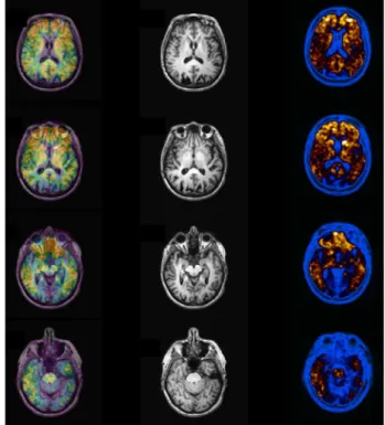 Figure 6. Normal amyloid PET example. Note normal uptake of PIB (Pittsburg  Compound) labeled with carbon-11 in white matter tissue at the left column