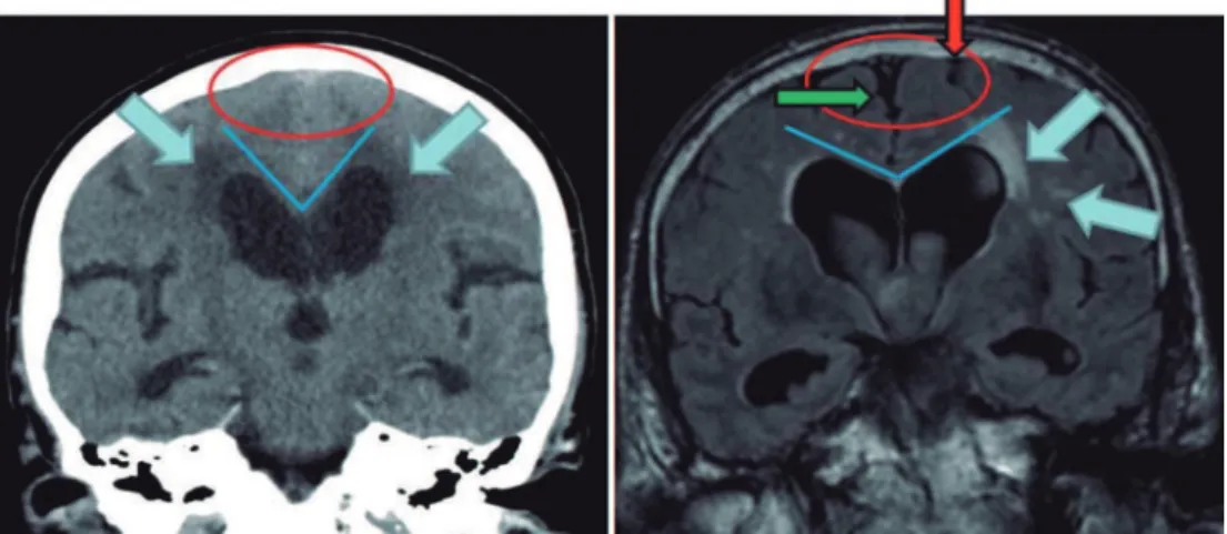 Figure 2. Coronal head CT (left) and MRI (right) at the level of the posterior commissure: in the left image, the CSF  spaces over the convexity near the vertex are narrowed (“tight convexity”, red circle), as are the medial cisterns  (red circle) - these 