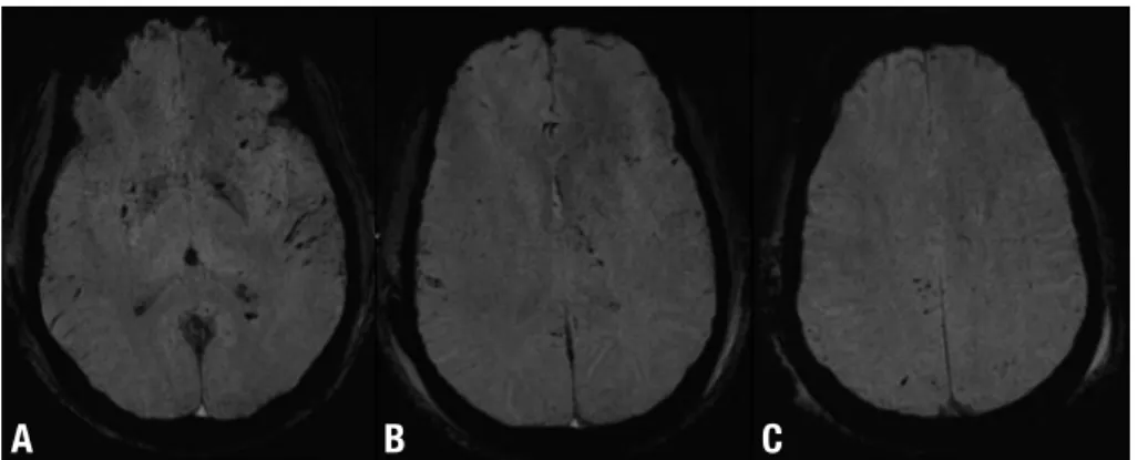 Figure 2. DAI and subarachnoid hemor- hemor-rhage after mild TBI. Axial SWI [A, B and  C] show multiple focal lesions involving  the basal ganglia and the lobar white  matter at the gray-white matter  inter-face