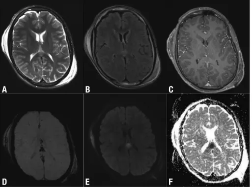 Figure 3. DAI involving the splenium of  the corpus callosum after TBI. Axial  T2-weighted [A], FLAIR [B], post-contrast  T1-weighted [C], SWI [D], DWI [E] and  ADC map [F] show high signal lesion  T2-weighted [A] and FLAIR [B] images,  with no enhancement