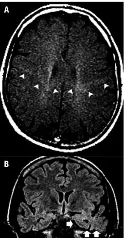 Figure 1. A man of 42 years of age presented with UMN + LMN signs as- as-sociated with dementia and language-speech abnormalities (his mother  had died at 67 years old with a diagnosis of ALS-FTD)