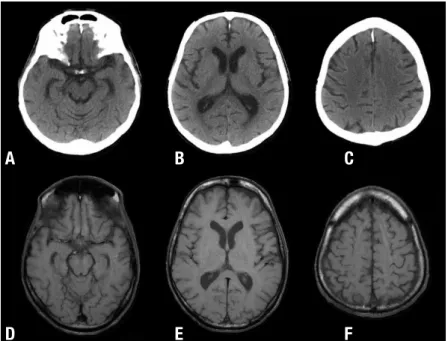Figure 1. [A, B, C] Conventional CT and [D, E, F] MRI  T1W images of two different patients with HAND,  showing changes of cerebral atrophy with  enlarge-ment of most CFS-containing spaces, including basal  cisterns, Sylvian fissures, cerebral ventricles a