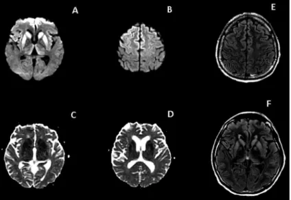 Figure 2. Case 1. Case 2: Axial DWI (A and B) shows hyper- hyper-intensity in basal ganglia, thalami, insular and frontal  cor-tex, with corresponding restricted diffusion in ADC maps (C  and D)