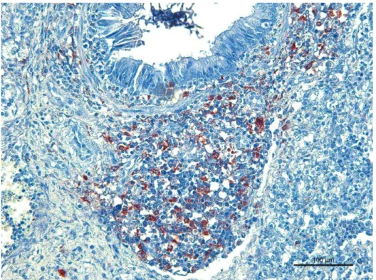 Figura 8 - IHQ, Influenza A em pulmão de suíno do Grupo 2  – Brônquio: Imunomarcação de cor vermelha no  citoplasma das células epiteliais e das glândulas bronquiais (AEC, hematoxilina, 200X)