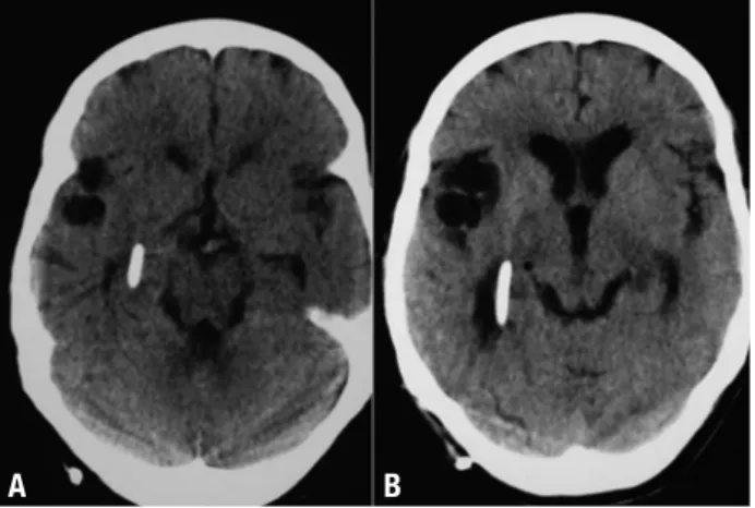 Figure 1. [A] Noncontrast brain CT-scan after first shunt derivation  shows catheter tip of ventricular peritoneal shunt into right lateral  ven-tricle, absence of ventricular dilatation and slight increase in right Sylvian  fissure