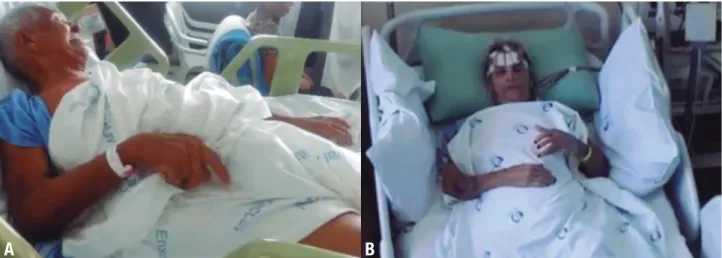 Figure 1. Faciobrachial dystonic seizures (FBDSsW). [A–B] Ictal stills of 2 patients. The ipsilateral face grimacing and arm posturing are visible in both  cases