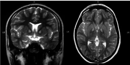 Figure 1. Coronal and axial T2-weighted MRI of patient A showing the “eye of the tiger sign”.