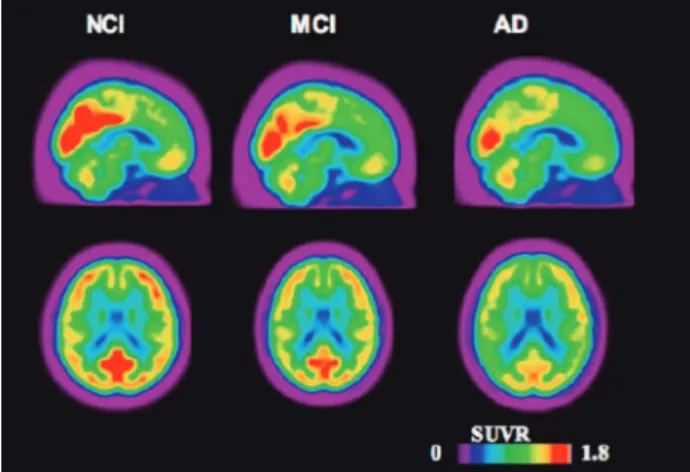Figure 2. Representative PET [ 18 F]FDG images acquired from a total of  103 individuals with normal cognition (NCI, N= 17), mild cognitive  im-pairment (MCI, N=52) and dementia due to AD (AD, N= 27) obtained  from a total of 103 structural MRI and [ 18 F]