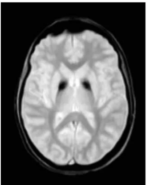Figure 2. T2-weighted magnetic  resonance imaging showing  symmetrical central hyperintensity  surrounded by hypointense signal in  globus pallidus, giving “eye of tiger” 