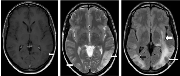 Figure 1. T1-weighted image post-contrast  reveals cortical-subcortical hypointensity in left  temporal lobe, without enhancement (white  arrow).